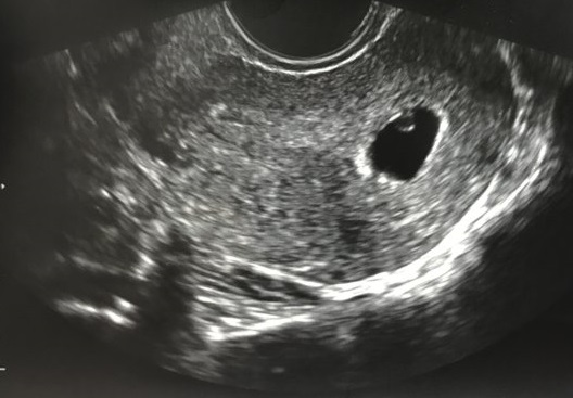 胎嚢 たいのう が小さいと流産するのか 妊娠週数毎の胎嚢の大きさとは お悩み解決モンくまnets